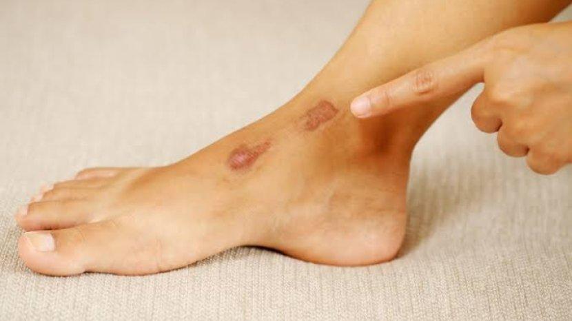 5 Rekomendasi Krim Penghilang Bekas Luka Ampuh dan Banyak Dicari, Salah Satunya Dermatix Ultra