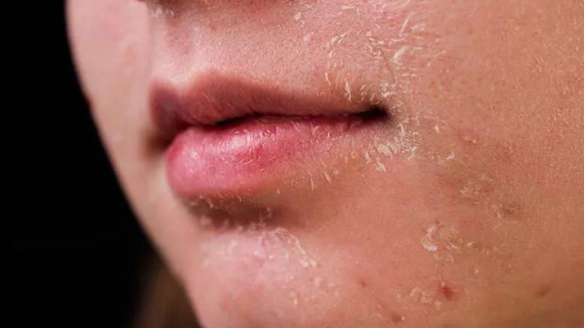 5 Rekomendasi Moisturizer untuk Melembapkan Kulit Kering dan Sering Mengelupas