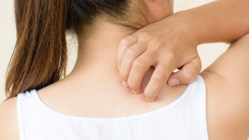 5 Tips Menghilangkan Panu dengan Mudah Pakai Bahan Rumahan