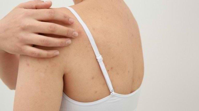 5 Bahan Alami yang Ampuh Mengatasi Jerawat di Badan yang Mengganggu