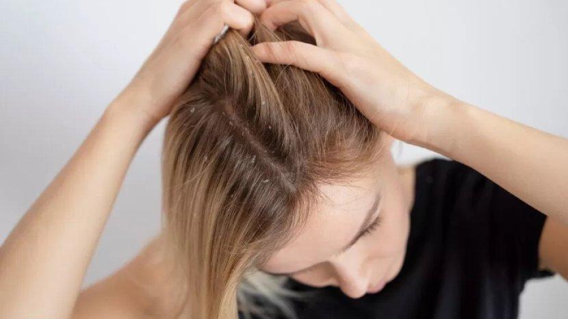 5 Tips Mudah Menghilangkan Kutu Rambut Dengan Bahan Rumahan