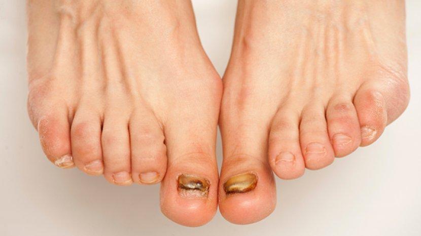 6 Cara Mengobati Cantengan di Kaki Tanpa Obat-obatan, Bahan Alami Cepat Sembuh