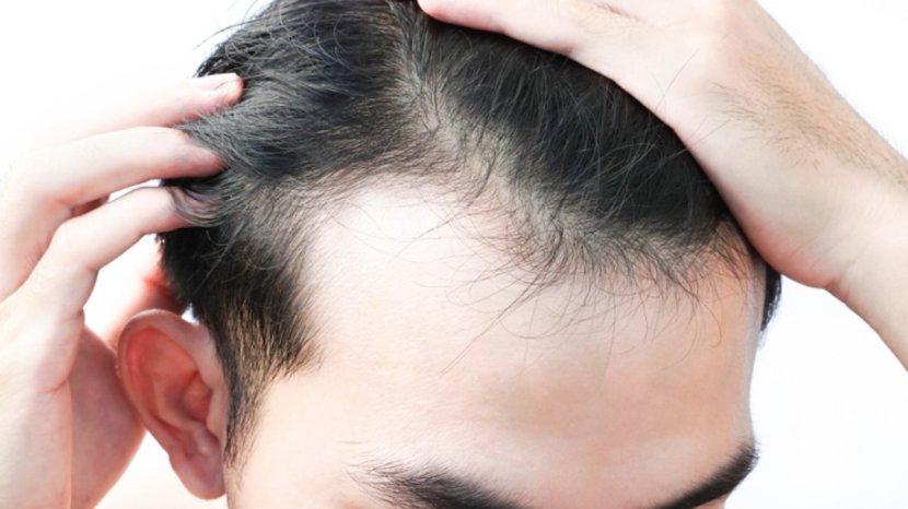 7-Cara-Ampuh-Hilangkan-Rambut-Gatal-dan-Berketombe-di-Kulit-Kepala.jpg