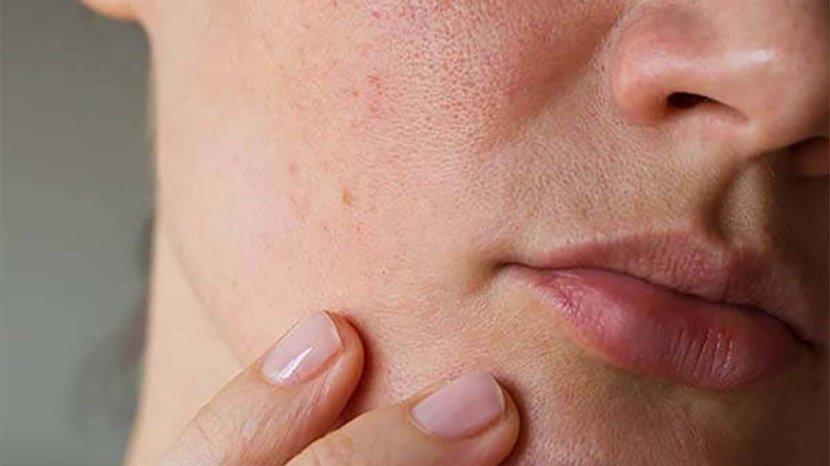 7 Cara Mengatasi Kulit yang Mudah Kering, Dimulai Dengan Menggunakan Sunscreen yang Melembabkan