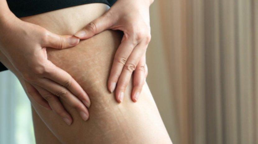 7 Cara Efektif Menghilangkan Strecth Mark di Paha, Bisa Menggunakan Retinol Hingga Laser