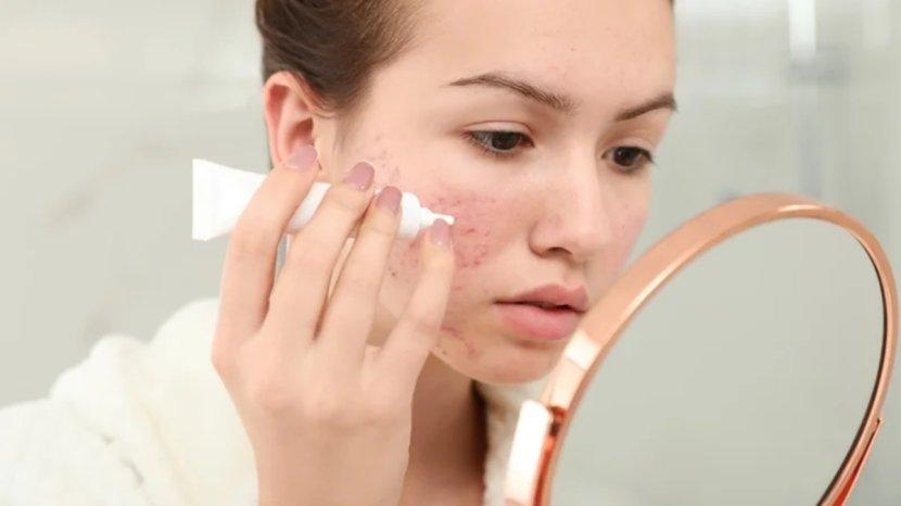 7-Rekomendasi-Acne-Spot-Treatment-100-Ribuan.jpg
