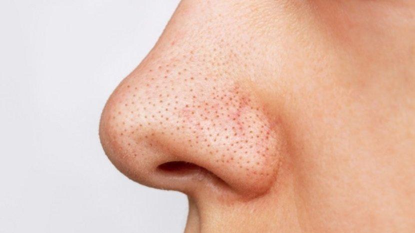 7-Rekomendasi-Produk-Skincare-Ini-Bagus-untuk-Bersihkan-Komedosdegw.jpg