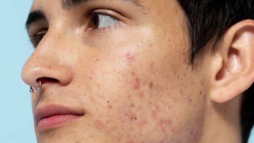 7-Rekomendasi-Skincare-Kulit-Pria-yang-Berjerawat.jpg