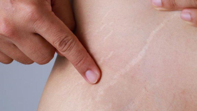 7-Tips-and-Trick-Mengatasi-Bekas-Stretch-Mark-Kembalikan-Warna-Kulit-Seperti-Semula.jpg