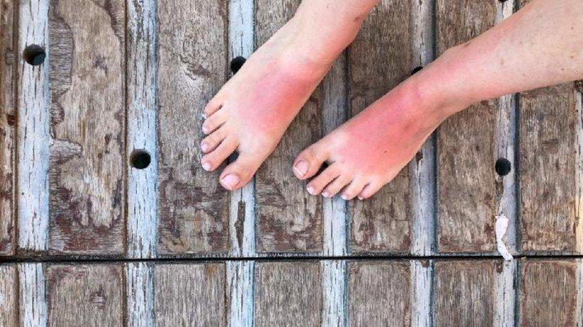 7 Tips dan Trik Atasi Kaki Bengkak dan Terbakar Karena Sinar Matahari