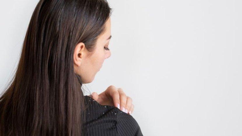 7-Tips-dan-Trik-Hilangkan-Ketombe-Pakai-Produk-Alami-Dijamin-Bebas-Bahan-Kimia.jpg