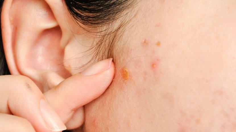 7 Tips dan Trik Menyembuhkan Jerawat yang Muncul di Telinga