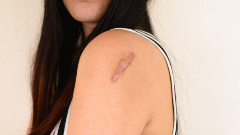 7 Bahan Alami Ini Diiklaim Ampuh untuk Mengatasi Keloid di Kulit, Bisa Hilang Tak Muncul Lagi