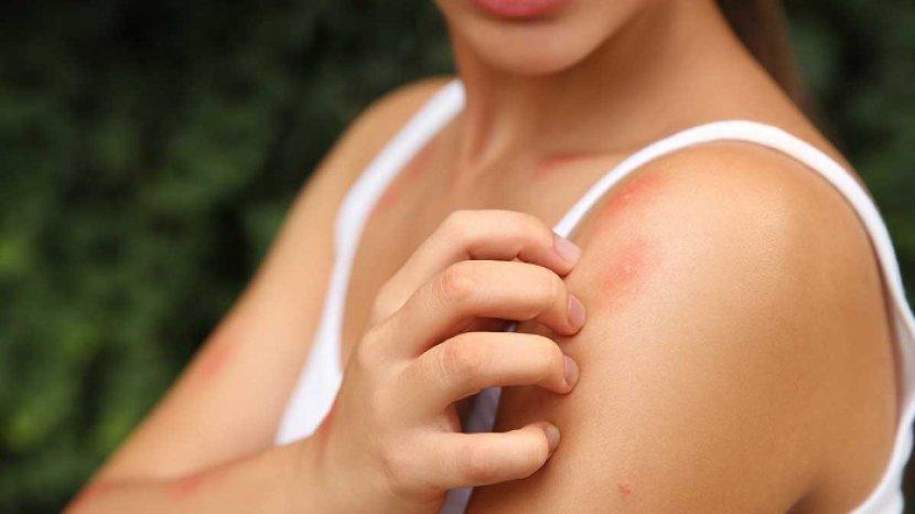 7 Bahan Alami untuk Menghilangkan Bekas Luka Akibat Gigitan Serangga