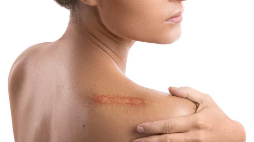 7 Tips Menghilangkan Keloid yang Mengganggu dengan Menggunakan Bahan Alami