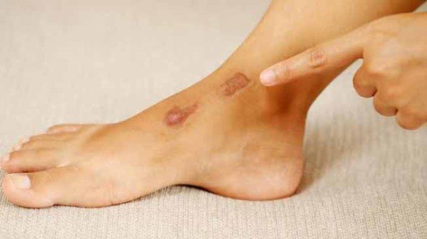 7 Bahan Herbal untuk Memudarkan Bekas Luka di Kaki yang Bikin Tidak Percaya Diri