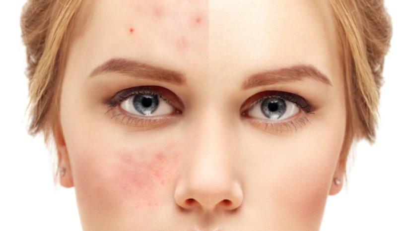 7 Ciri-ciri Skin Barrier Kamu Rusak, Segera Atasi Menggunakan Skincare