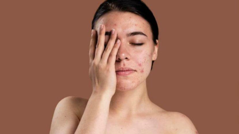 7 Pertanda Skin Barrier Rusak dan Cara Sederhana untuk Menyembuhkannya