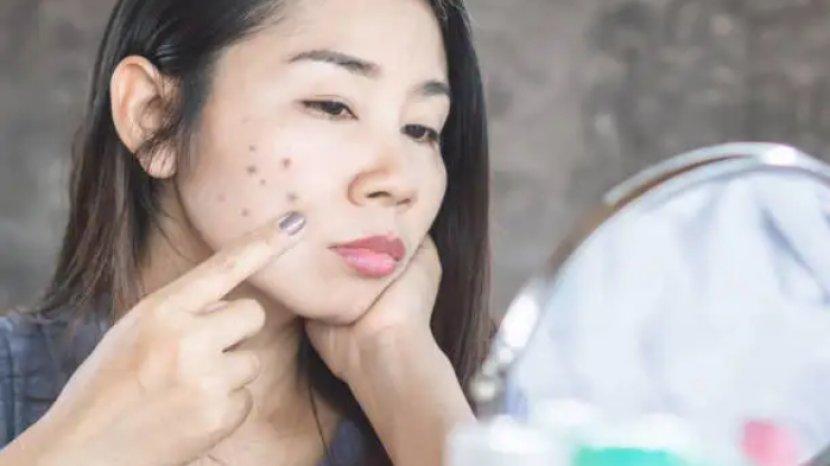 7 Rekomendasi Dark Spot Serum yang Ampuh Menghilangkan Noda Hitam di Wajah