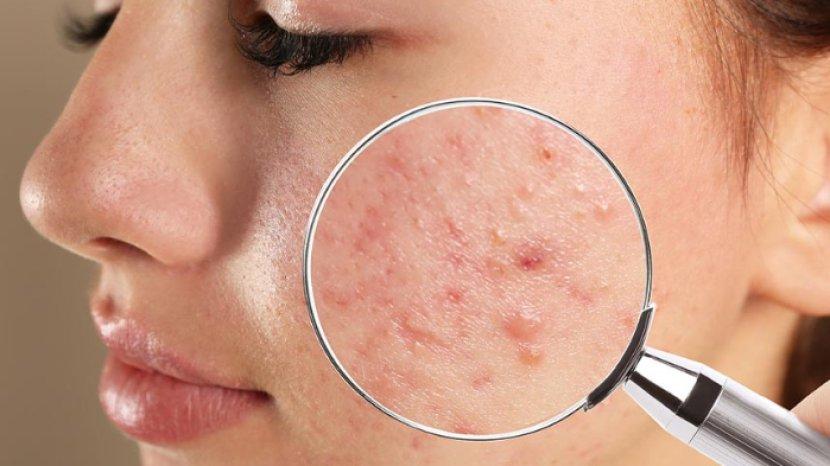 Kenali 7 Ciri-ciri Skincare Tidak Cocok di Kulitmu, Salah Satunya Muncul Ruam Kemerahan