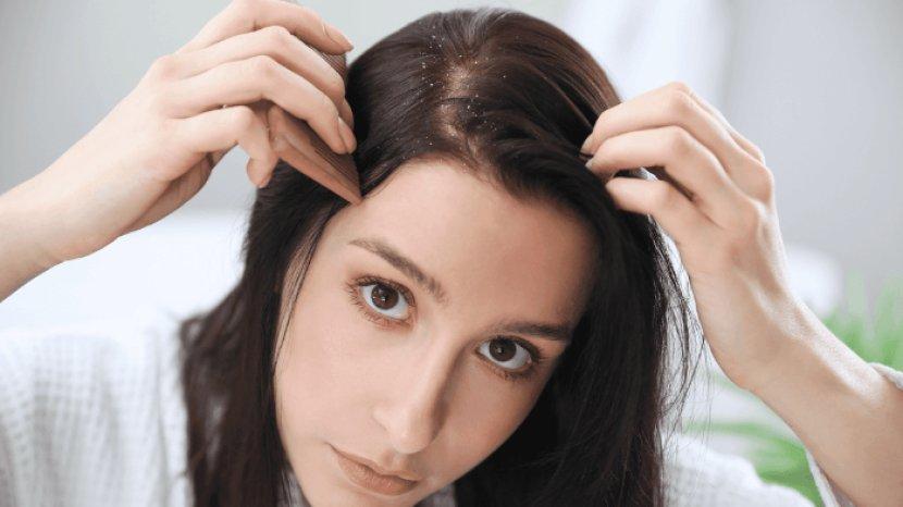7-tips-hilangkan-kutu-rambut-dan-telurnya-yang-membandel-kulit-bersih-bebas-gatal-dan-lepek.jpg