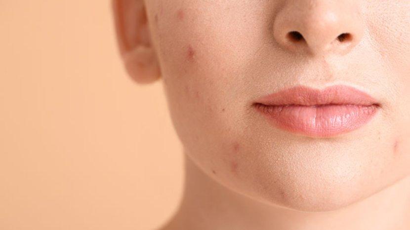 8-Hal-Sepele-yang-Bikin-Jerawat-Makin-Parah-Salah-Satunya-Terlalu-Sering-Cuci-Muka-de.jpg