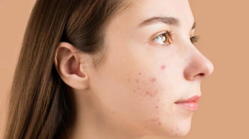9 Cara Hilangkan Bopeng Bekas Jerawat di Wajah Pakai Bahan Alami