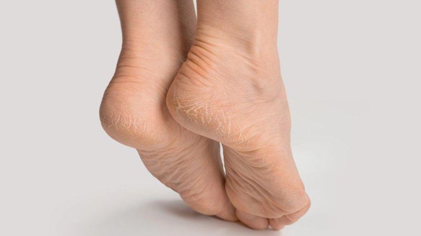 Atasi-Kaki-Pecah-pecah-Saat-Cuaca-Panas-Pakai-Bahan-Alami-Dijamin-Bebas-Kering.jpg