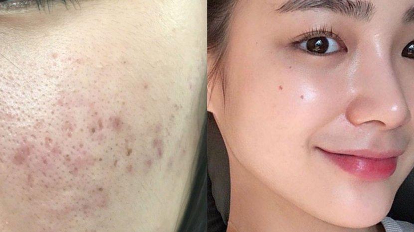 7 Kandungan Skincare yang Bisa Menghilangkan Noda Hitam Bekas Jerawat
