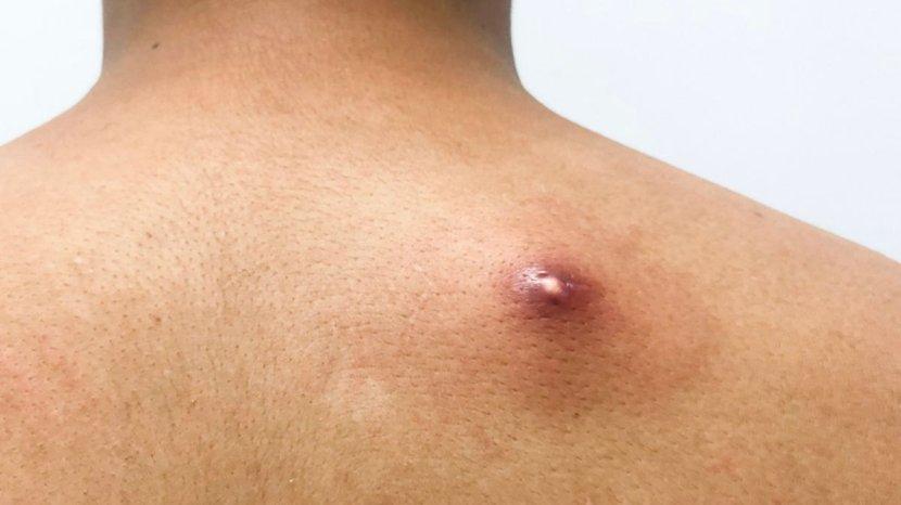 6 Obat Bisul Alami yang Bisa Kamu Coba di Rumah, Dipercaya Ampuh Mengatasi tanpa Efek Samping