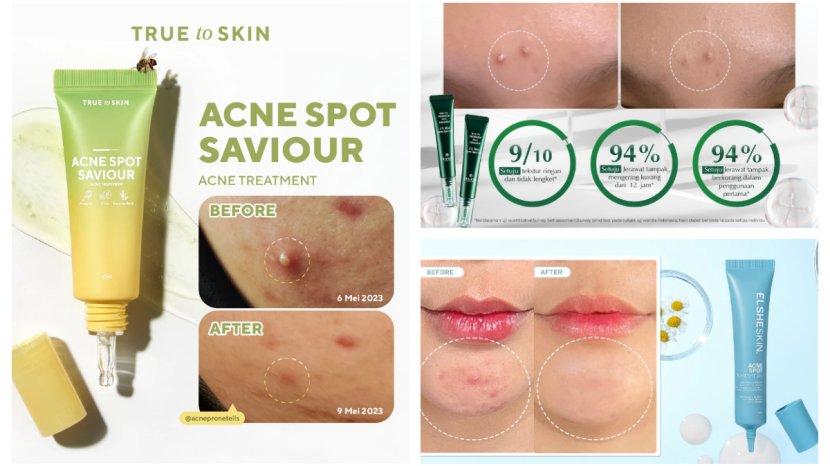 Daftar-obat-totol-jerawat-terbaik-yang-aman-dan-sudah-BPOM.jpg