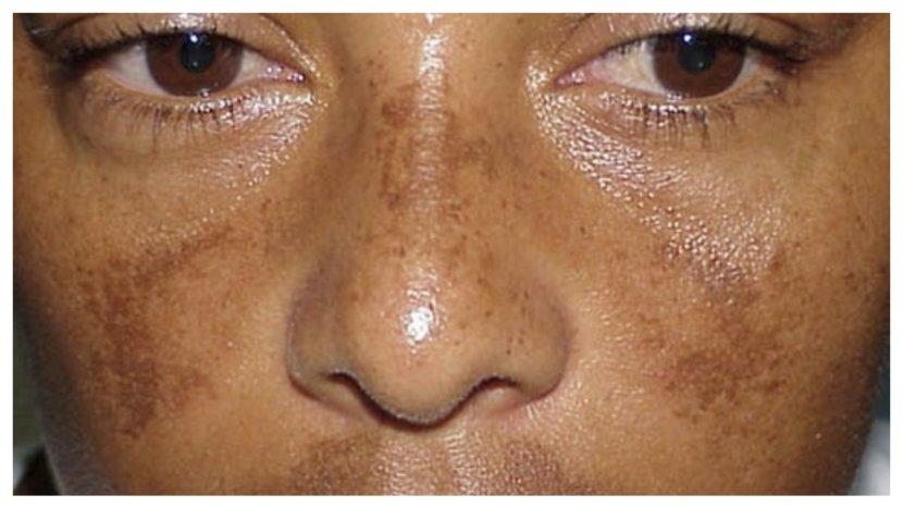 6 Bahaya Hidrokuinon Terhadap Kulit, Bahan Kosmetik yang Dilarang BPOM