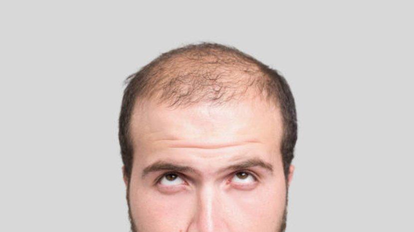 7 Tips dan Trik Menyuburkan Rambut Pakai Bahan Alami, Kulit Kepala Bebas Botak