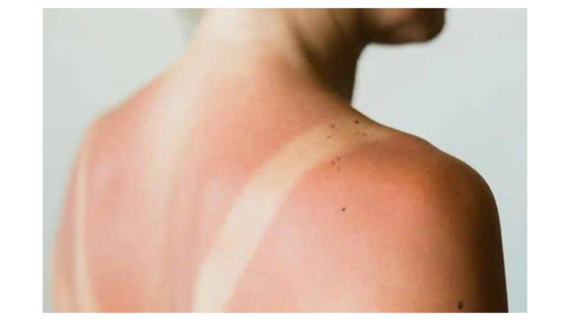 Solusi Body Care untuk Mengatasi Kulit Belang Akibat Sinar Matahari