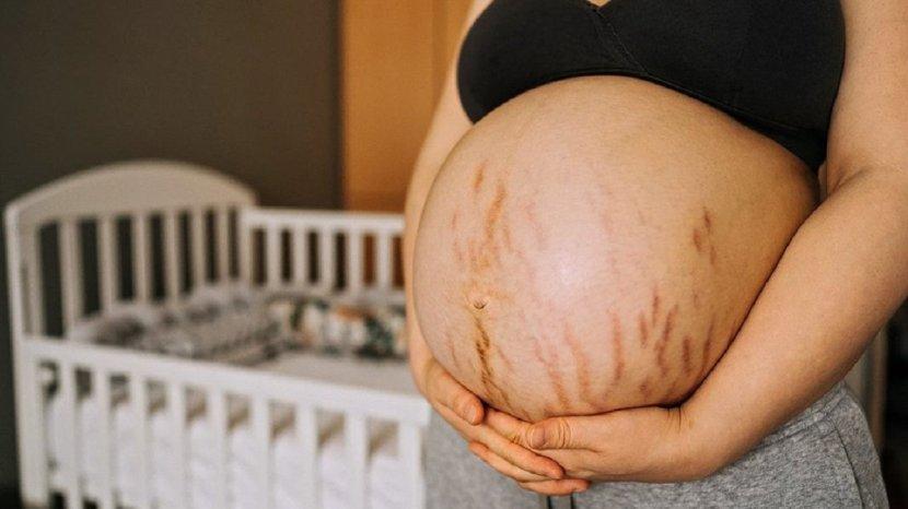 40 Daftar Produk Cream Penghilang Stretch Mark yang Ampuh untuk Ibu Hamil dan Menyusui