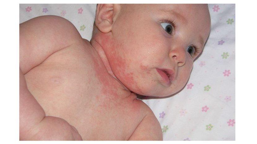 7 Tips Mengatasi Biang Keringat pada Bayi Secara Alami agar Kulit Tetap Sehat dan Lembut