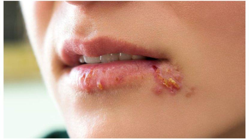 Muncul Herpes di Wajah? Ini 7 Bahan Alami yang Terbukti Membantu Mengatasinya