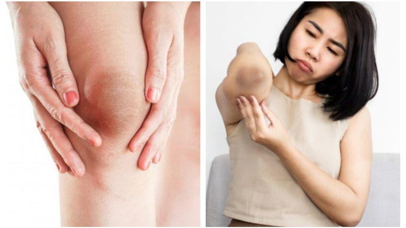 Lutut-dan-siku-yang-menghitam-bisa-diatasi-dengan-bahan-alami.jpg