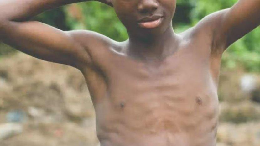 Dari Anak sampai Dewasa, Begini Cara Cegah Marasmus dengan Dukungan Susu Flyon