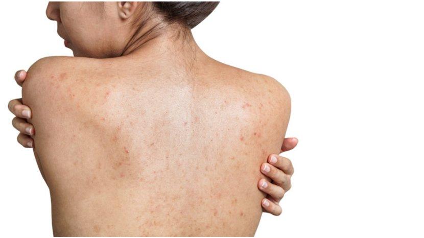 Masalah-jerawat-punggung-bisa-diatasi-dengan-beberapa-bahan-alami3.jpg