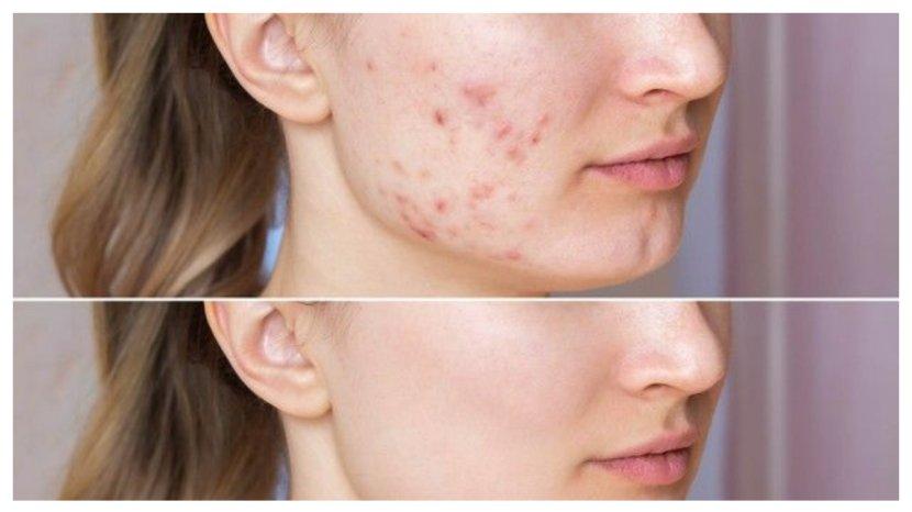 9 Cara Mudah Mengatasi Masalah Jerawat dari Dalam, Hanya Perlu Diminum Rutin