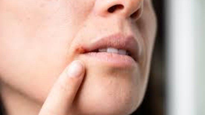 Obat Herpes Paling Ampuh, Manfaatkan 5 Bahan Alami Ini untuk Meredakan
