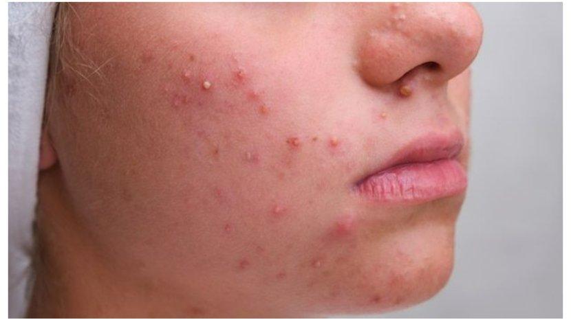Penyebab-jerawat-tak-kunjung-teratasi-meski-sudah-pakai-skincare.jpg