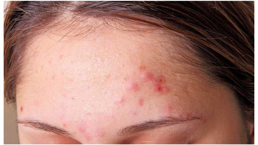 Penyebab-jerawat-tak-kunjung-teratasi-meski-sudah-pakai-skincare2.jpg