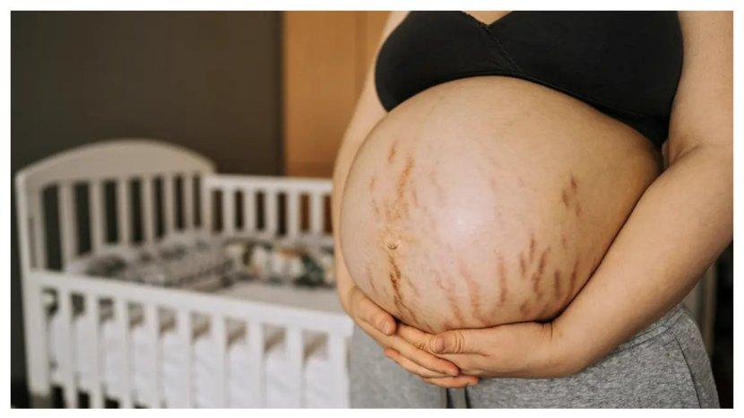 Stretch-mark-di-masa-kehamilan3.jpg