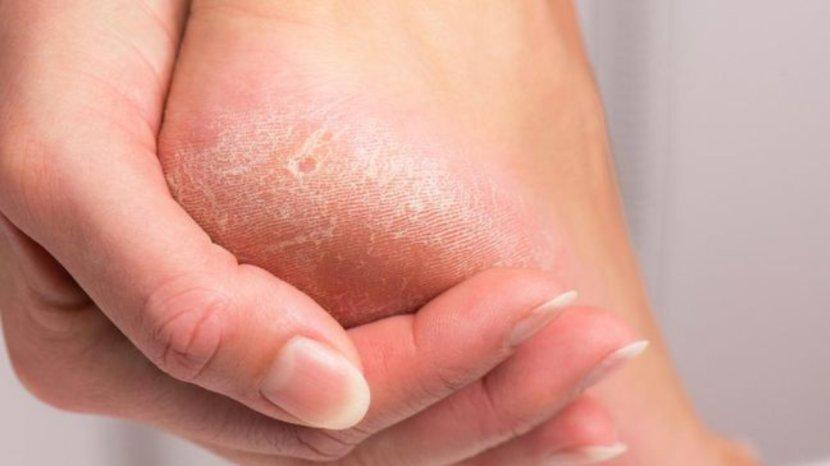 Telapak Kaki Kering Pecah-pecah Bukan Lagi Jadi Masalah Dengan 5 Tips dan Trik Ini