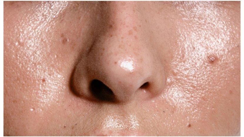 9 Kandungan Skincare yang Cocok untuk Kulit Berminyak, Bisa Mengontrol Sebum hingga Cegah Jerawat