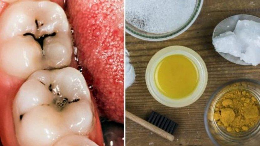 Bahan Tradisional Ini Dapat Mengatasi Gigi Berlubang, Yuk Kenali Apa Saja
