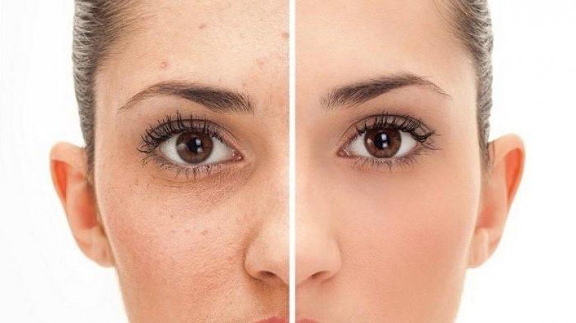 7 Bahan Alami Hilangkan Bopeng Bekas Jerawat di Wajah Tanpa Perlu ke Skin Care