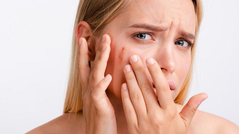 6 Bahan Alami Mengatasi Herpes di Wajah yang Mengganggu Penampilanmu